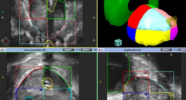 biopsia transperineal próstata mediante fusion rmn)