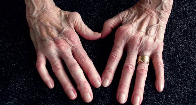 The Lancet” publica los resultados de upadacitinib en el estudio fase 3  SELECT-MONOTHERAPY en artritis reumatoide - Gaceta Médica
