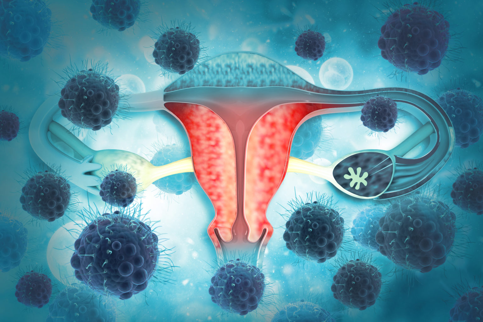 Cancer de endometrio se cura