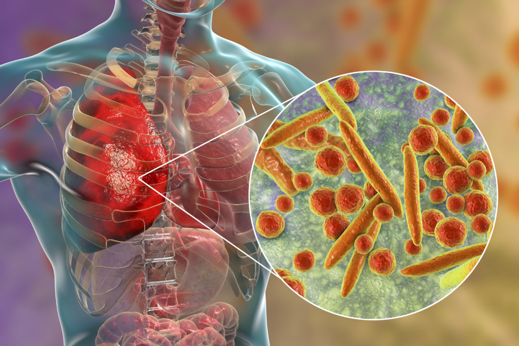 Infección pulmonar por 'Mycoplasma pneumoniae'