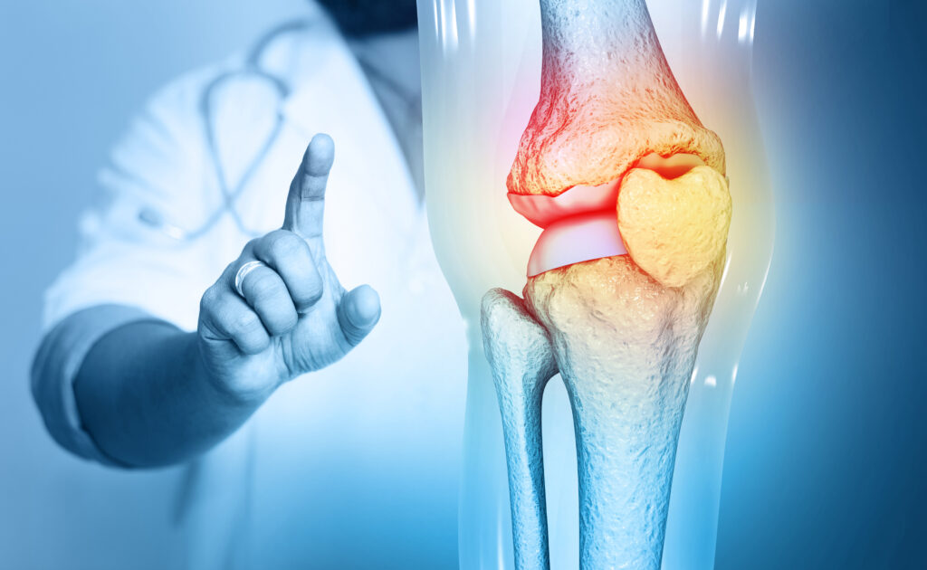 Semaglutide relieves pain in knee osteoarthritis