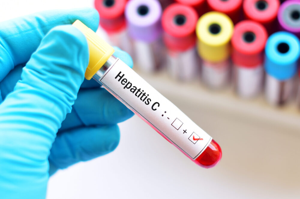 Spain moves towards eliminating hepatitis C as a public health problem