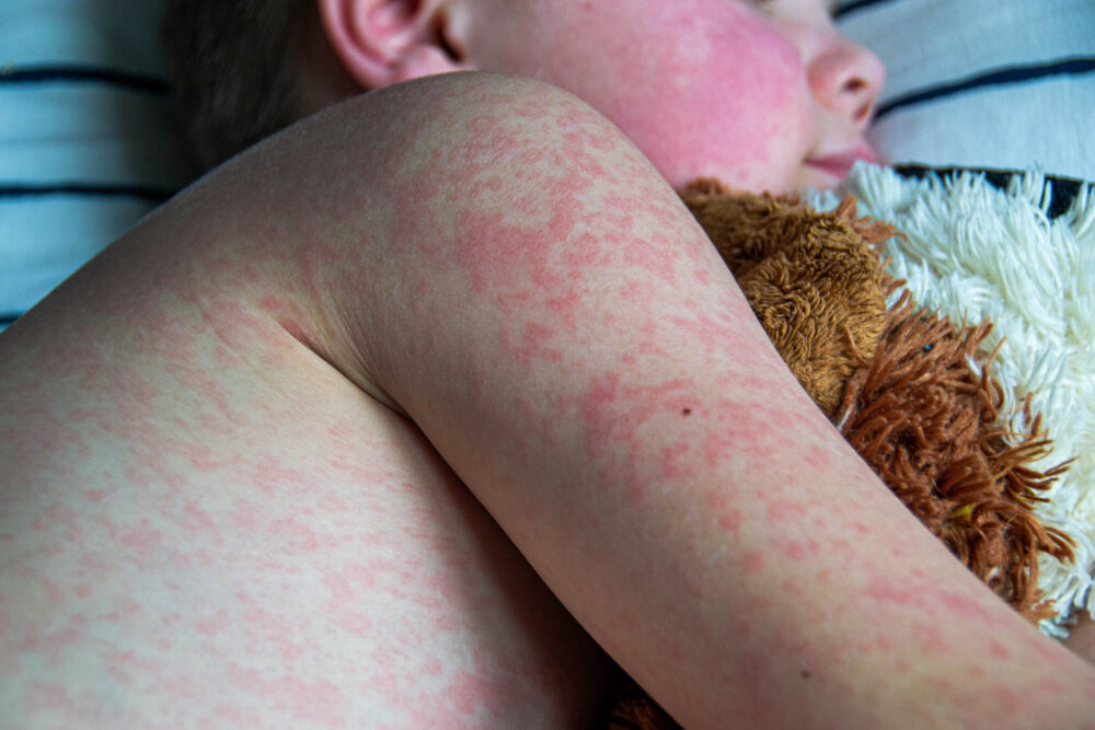 WHO warns that measles incidence has increased by 20% worldwide